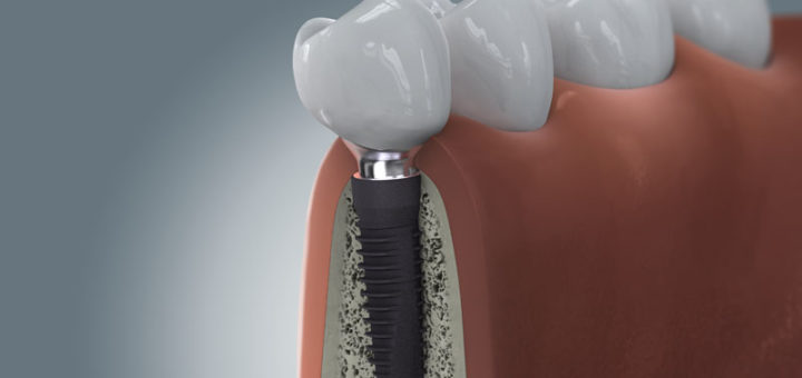 Zahnimplantate